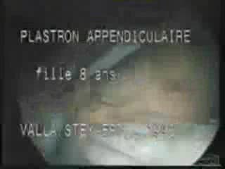 Appendicectomie par laparoscopie - Le problème du plastron appendiculaire