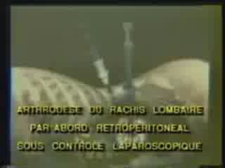 Arthrodèse lombaire par vidéo chirurgie assistée
