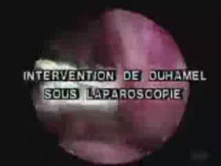 Intervention de Duhamel sous laparoscopie