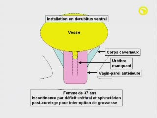 Reconstruction de l'urèthre féminin en vagin et plastie des corps caverneux
