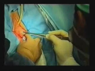 Traitement du prolapsus utérin par voie vaginale exclusive avec prothèses : technique originale