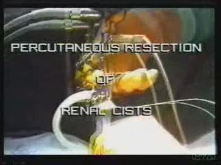 Percutaneous resection of renal cists