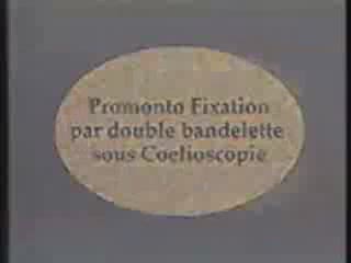 Promontofixation par double bandelette sous coelioscopie