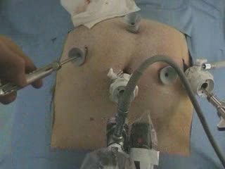 Technique de l'anastomose vesico-urétrale lors de la prostatectomie radicale laparoscopique