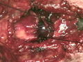 Opération de Caléaro ou chirurgie laryngée partielle - Trans-laryngée glottique