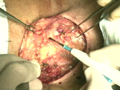 Opération de Tücker ou chirurgie laryngée partielle frontale antérieure avec reconstruction 