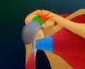 Réinsertion de la coiffe des rotateurs sous arthroscopie