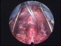 Résection anastomose trachéale ou crico-trachéale