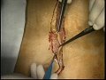 Traitement chirurgical des éventrations de la paroi abdominale antérieure 