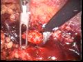 Urétérotomie lombaire sous lomboscopie 