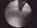 Voie antéro latérale du rachis cervical bas C3-C7 