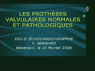 DIU d'échocardiographie - Les prothèses valvulaires normales et pathologiques
