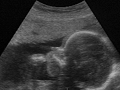 L'examen échographique au deuxième trimestre de grossesse